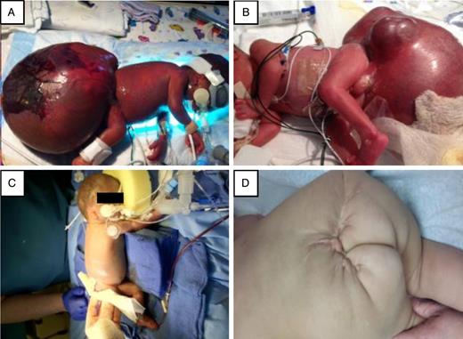(A) At Day 0, a GSCT (15 × 12 × 16 cm) is noted with skin necrosis on the left decubitus position. (B) Irregular multinodular contour noted on GSCT on the right decubitus position. (C) Infant on post operative day 0 after GCST resection. (D) Infant at 15 month follow up.