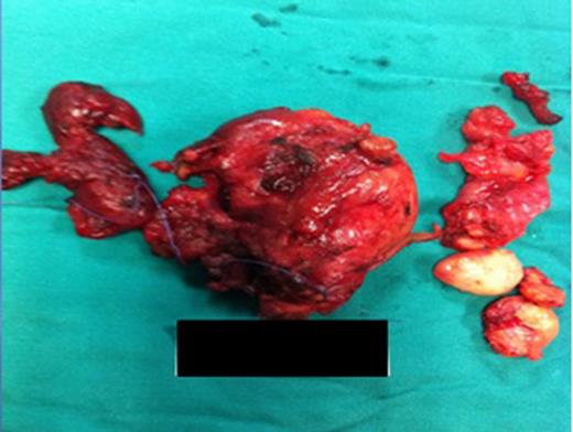 Surgical specimen: thyroid gland with an enlarged left lobe (retrosternal extension).