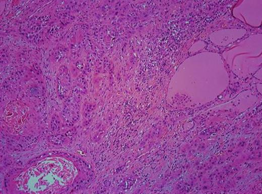 H/E ×100 section from the left lobe of the thyroid gland showing infiltrative SCC.