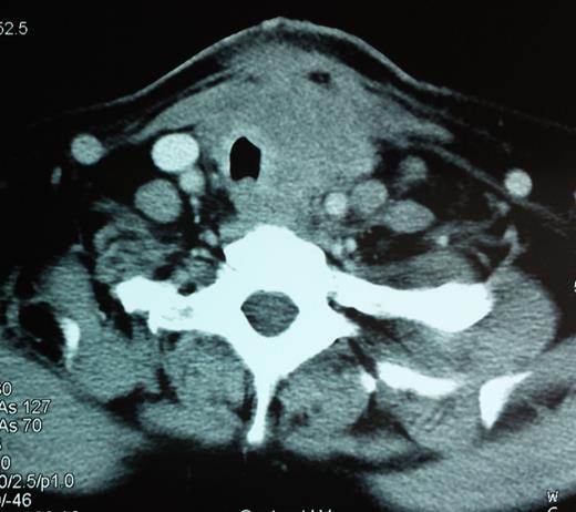 A CT scan showing a 6.2-cm mass pressuring and infiltrating the trachea and surrounding soft tissue.