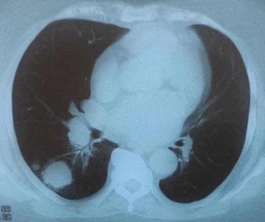 A CT scan showing metastasis to the right lung.