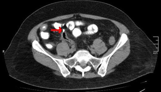 A CT scan showing the upper edge of the biliary stent perforating the antimesenteric surface of the sigmoid colon (red arrow).