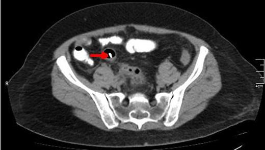 A CT view of the same patient showing the lower edge of the biliary stent perforating the sigmoid colon (red arrow).