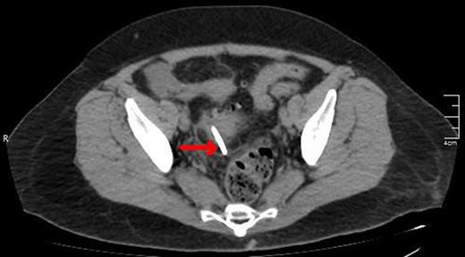 A lower CT view of the same patient showing the stent (red arrow).
