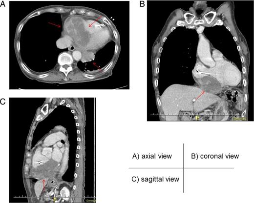 Axial (A), coronal (B) and sagittal (C) views of enhanced computed tomography. A tumor (arrow) measuring 90.0 × 56.4 × 60.0 mm, with heterogenous low enhancement and an unclear border invaded into the inferior myocardium.