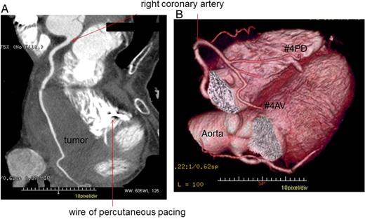 Computed tomographic coronary angiography. The right coronary artery penetrated the tumor with no significant signs of invasion (A) or displacement (B). The wire used for percutaneous pacing was placed in the right ventricle.