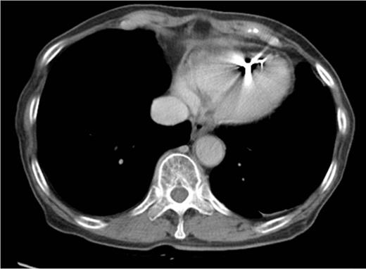 Enhanced computed tomography after chemotherapy. The tumor could not be detected.