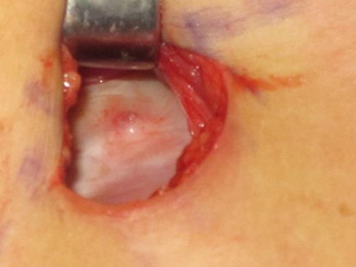 The spur of bone on the right chest wall of the 42-year-old patient immediately after removal of the deflated implant.