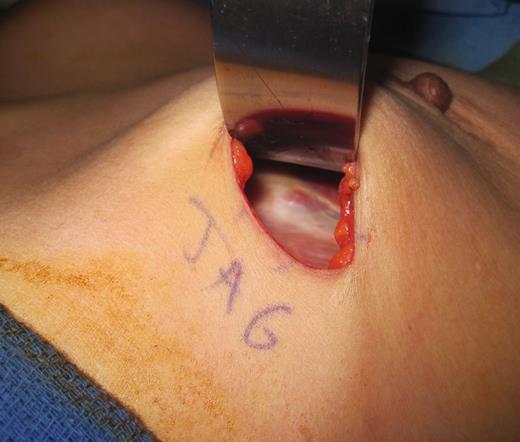 The bone spicule similar to that found on the right but this time on the left chest wall immediately after implant removal.