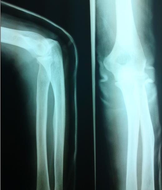 Posterior splint was applied in ED and X-rays showed no fracture, no dislocation.