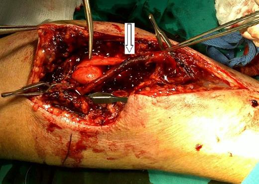 Intact adventitia of the brachial artery (arrow), also the median nerve seen stretched over the articular surface of the distal part of humerus, is intact (scissors).
