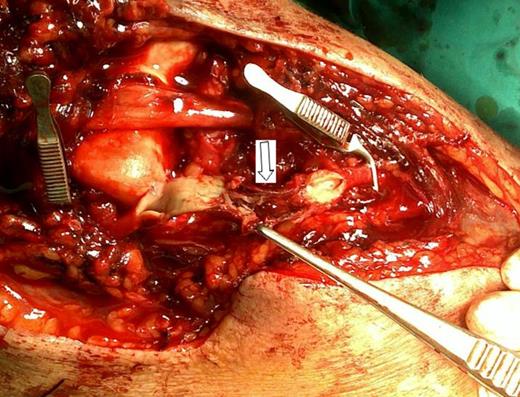 Loss of intima in all the entire circumference of the brachial artery in a 1-cm segment (arrow).