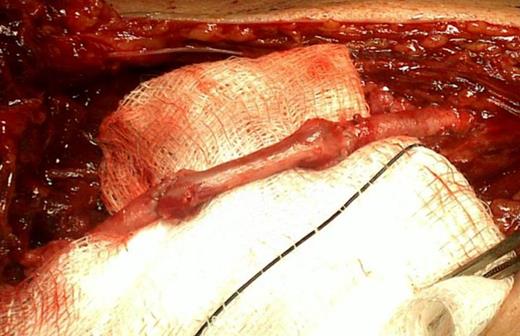 Complete arterial repair using an end-to-end reversed saphenous bridge.