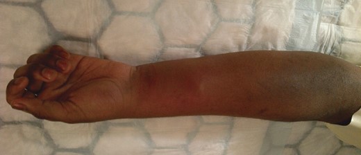 Image of the left forearm with swelling and with the wrist and fingers held in a flexed position.