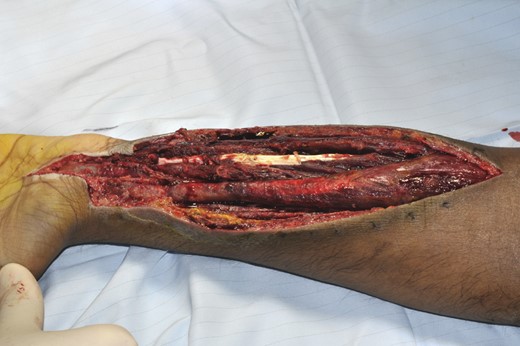 Intra-operative image demonstrating the approach used and underlying muscle damage.