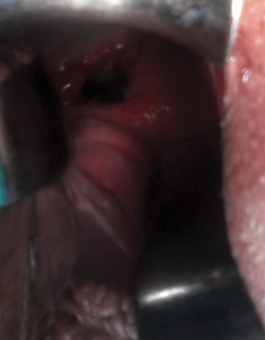 Vaginal Vault Dehiscence associated with intra-abdominal hematoma after postpartum hysterectomy.