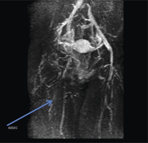 Magnetic resonance venogram showing communication of thigh veins to vulval varices (blue arrow).