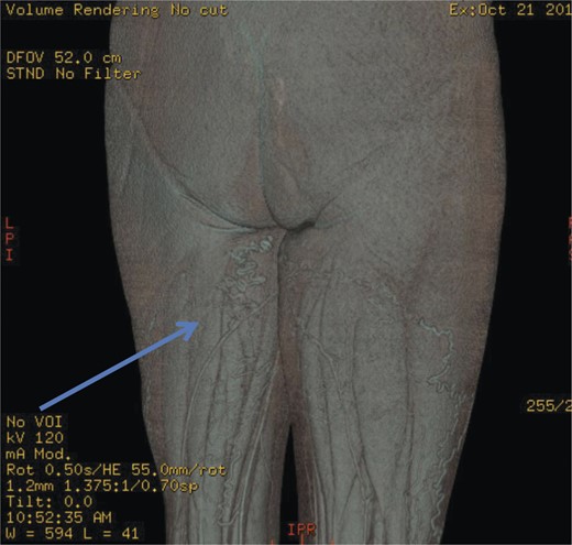 Computed pelvic venography showing communication of thigh veins to vulval varices (blue arrow).