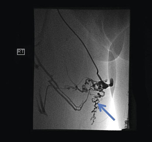 Pre-embolization fluoroscopy showing communication of thigh veins to vulval varices (blue arrow).