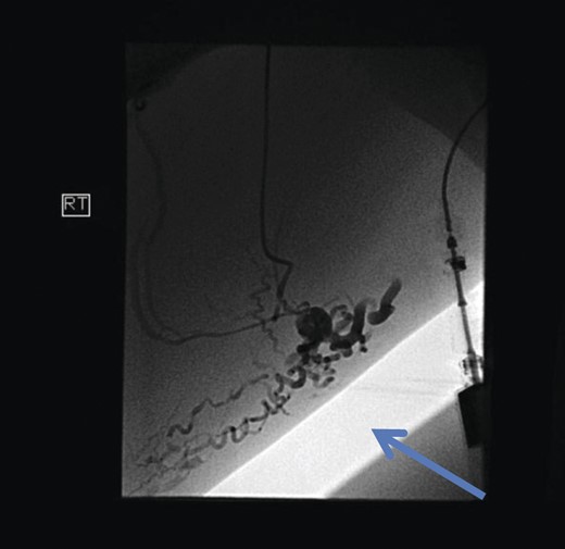 Pre-embolization fluoroscopy showing communication of thigh veins to vulval varices (blue arrow).