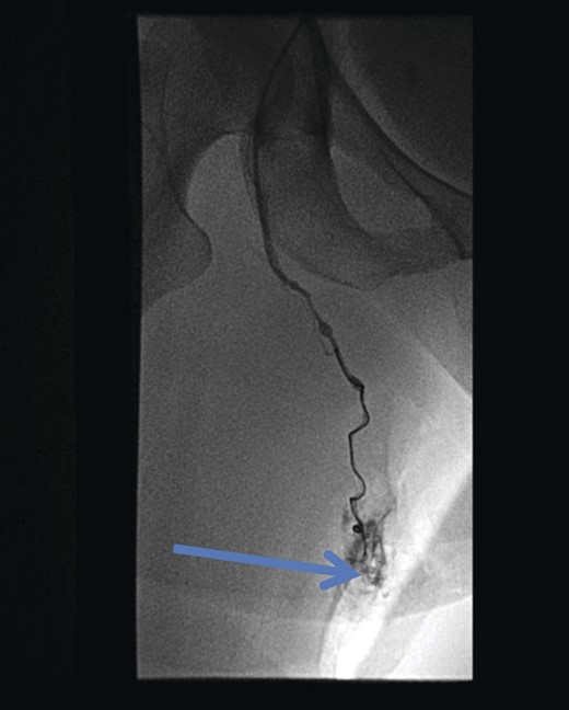 Post-procedure fluoroscopy showing successful obliteration of communication of thigh veins to vulval varices (blue arrow).