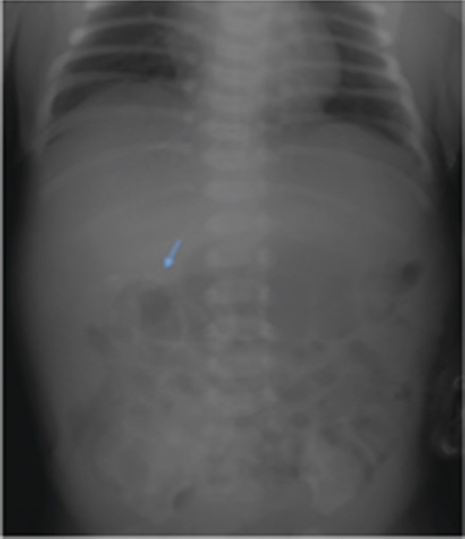 Calcifications seen over right upper abdomen on radiograph.