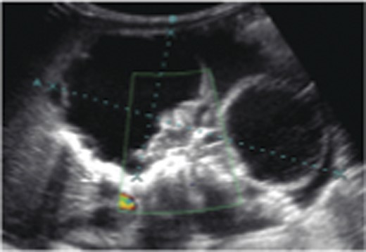 Sonographic long bones.
