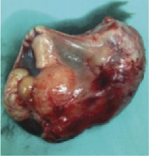 Resected specimen seen encapsulated by a thin, intact membrane.