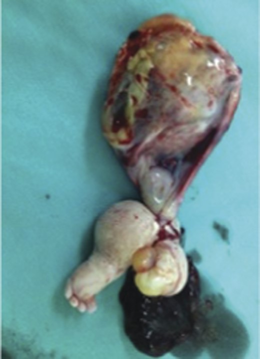 Rudimentary limb buds and an anencephalic fetus extracted from the sac.