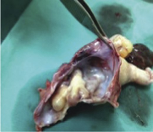 The divided sac containing rudimentary pulmonary structures.