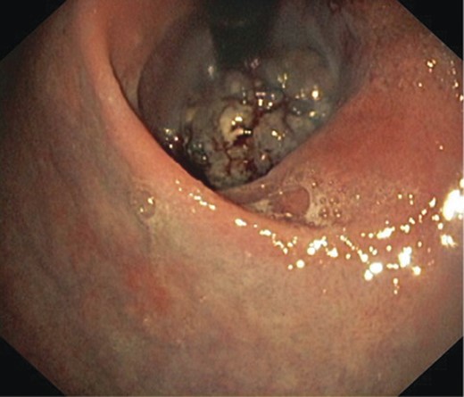 An endoscopic view of the fungating melanoma involving most of the oesophageal lumen.