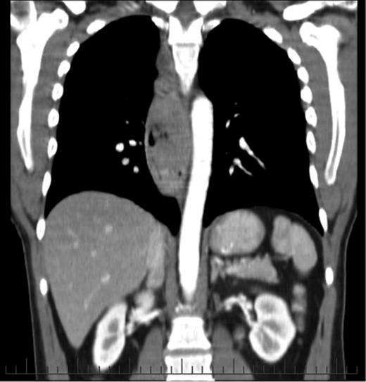 Extensive mediastinal lymphadenopathy on staging CT scan.