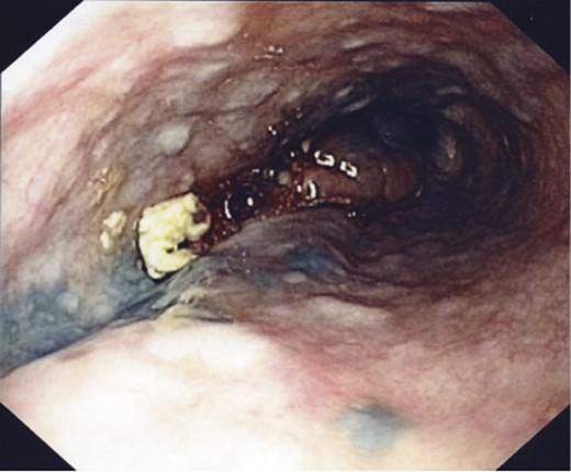 An endoscopic view of the oesophageal melanoma with numerous adjacent satellite lesions.
