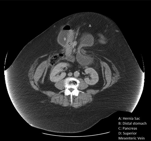 CT scan shows the pancreas in the hernia sac.