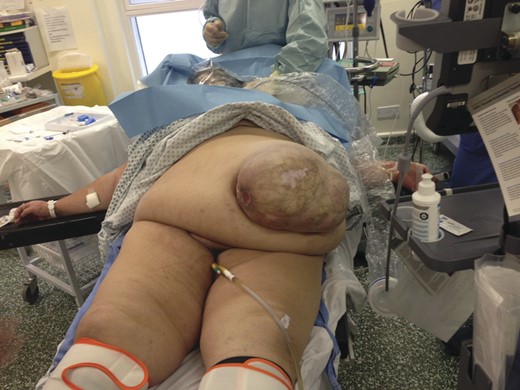 Morbidly obese patient with large umbilical hernia prepared for emergency laparotomy.