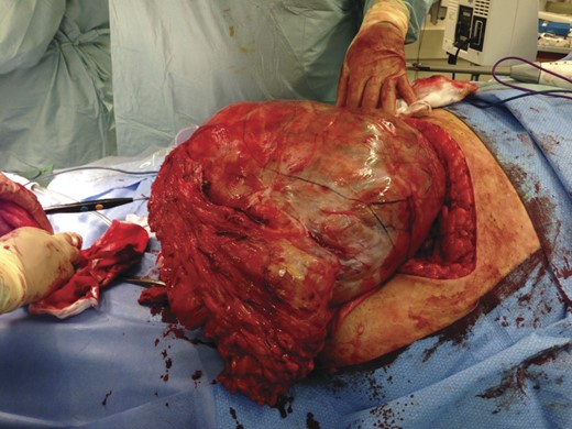 Large hernia sac containing multiple abdominal viscera.