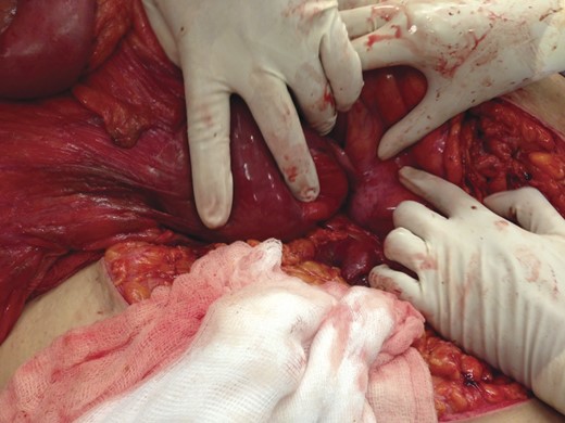 Sac opened and pancreas is seen within it.