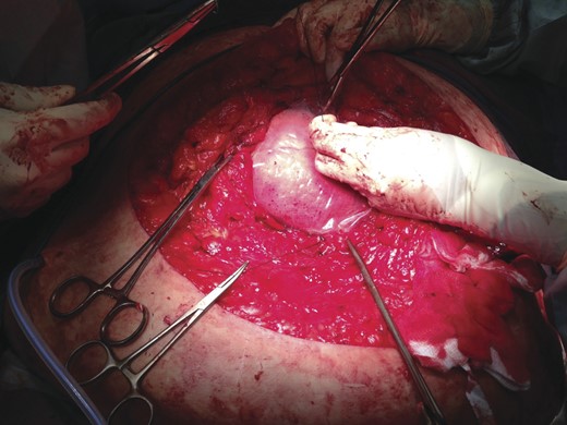 Temporary repair of the abdominal defect using a bagota bag.