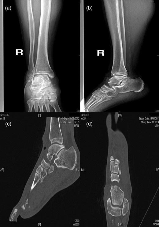 AP (a) and lateral (b) radiographs and CT images (c, d) confirm the diagnosis of the loss of talus head during the trauma.