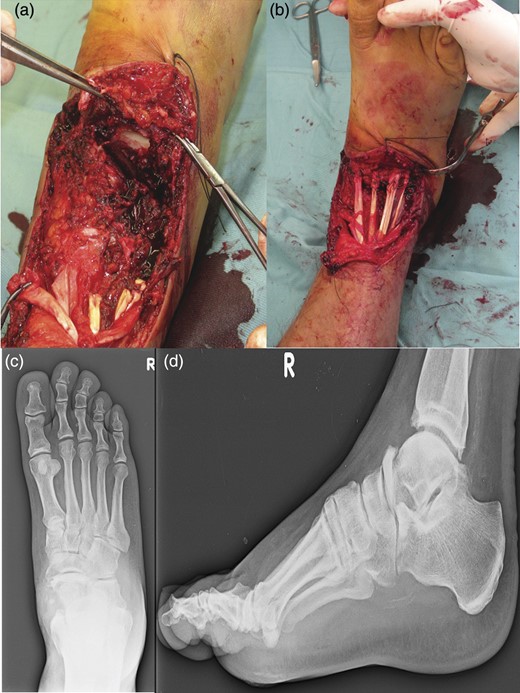 An image of the foot before the first-time surgical repair reveals the injuries of dorsalis pedis artery, tibialis anterior tendon, estensor digitorum longus tendons, peroneus tertium tendon, with the loss of talus head and with a complex lesion of the talonavicular ligament. (a) Tendinous structures damaged were surgically sutured and subsequently an antibiotic-loaded cement spacer was positioned into the bone gap to reestablish the joint congruence (b). AP (c) and lateral (d) radiographs of the foot in the cast after the surgical time.