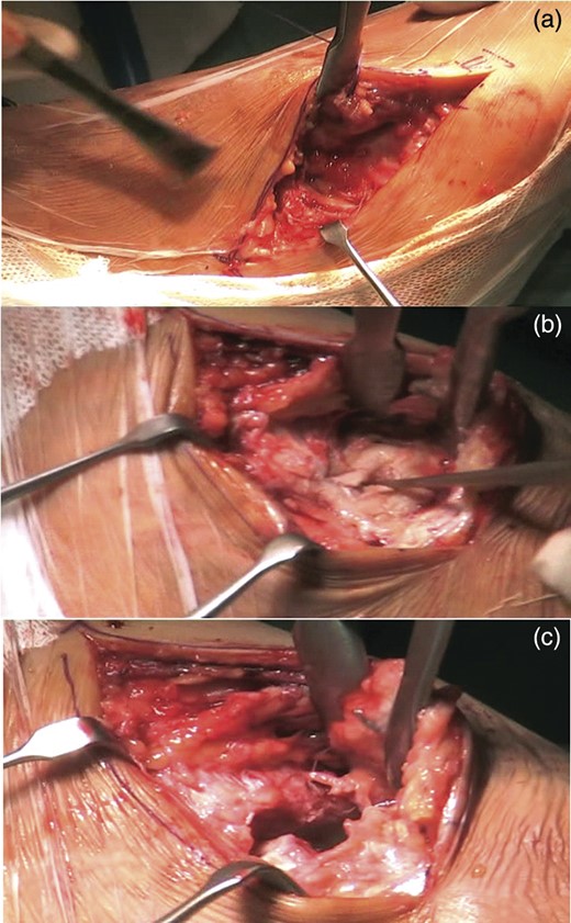 Lateral approach at the base of the fourth metatarsal, and extended proximally toward the tip of the fibula, ∼1 cm short of the tip to identify the calcaneocuboid joint (a). Medial approach through a longitudinal incision, starting at the tip of the medial malleolus and carried distally 1 cm past the naviculocuneiform joint. It is evident of the antibiotic-loaded cement spacer. (b). An elevator was passed over the dorsal aspect of the talonavicular joint. The antibiotic-loaded cement spacer was removed (c).