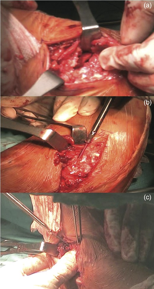 The placement of an autologous graft into the talonavicular joint harvested from the omolateral iliac crest (a). The fixation of the calcaneocuboid joint was carried out using two 4.0-mm cannulated screws (b) and the talonavicular joint was fused in situ using two 4.0-mm cannulated screws across the talonavicular joint (c).