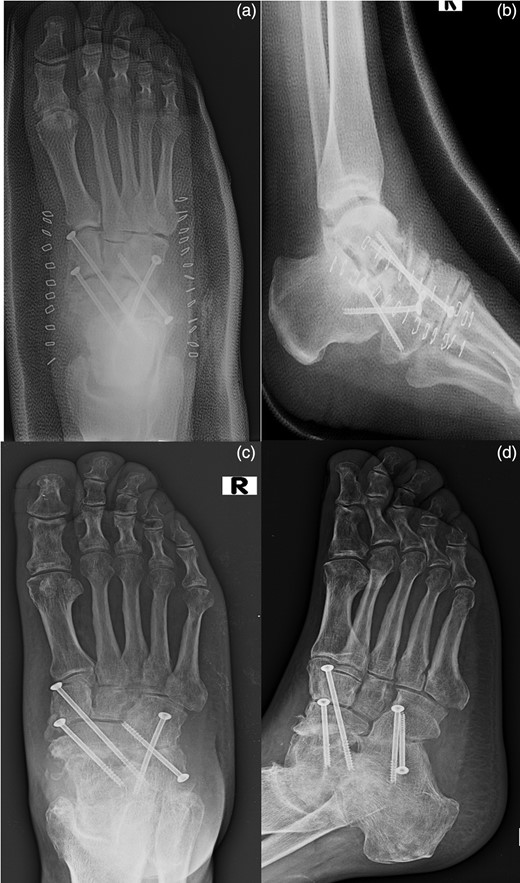 AP (a) and lateral (b) radiographs of the foot in the cast after the surgical time. AP (c) and lateral (d) radiographs of the foot at the sixth month follow-up.