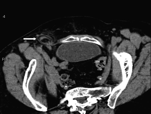 A axial section illustrating a right femoral hernia through the femoral canal at the level of pubic tubercle.