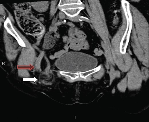 A coronal section showing the tip of the appendix (white arrow) protruding through the femoral canal, medial to femoral vein (red arrow) into the hernia. The appendix measures 10 cm.