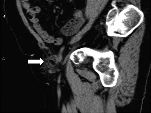 A saggital section demonstrating the tip of the appendix (white arrow) within the femoral sac.
