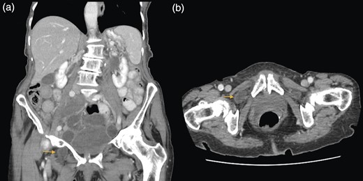 (a and b) Small bowel obstruction secondary to a right OH. (a) Coronal and (b) axial.