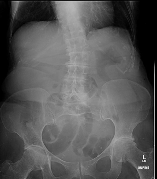Abdominal x-ray showing dilated small bowel loops and severe osteoarthritis changes in both hips.