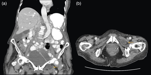 (a and b) Small bowel obstruction secondary to a left OH. (a) Coronal and (b) axial.