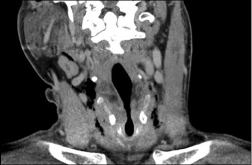 CT scan showing subcutaneous emphysema of the larynx.
